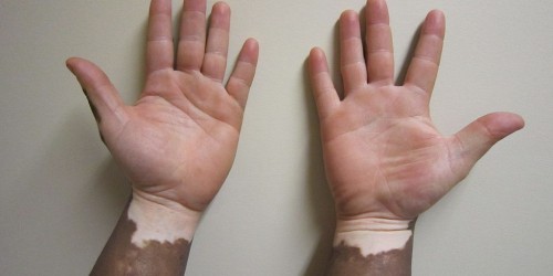Vitiligo Gene May Protect Against Deadly Malignant Melanoma