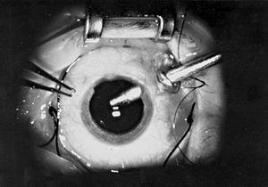 Vitrectomy eye surgery