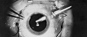 Vitrectomy eye surgery