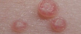 Umbilicated Lesions or Genital Warts