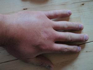 Wasp bite treatment