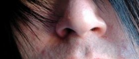 Ways to get rid of acne fast
