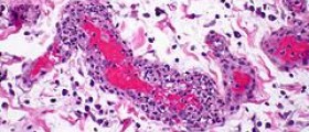 Wegener's granulomatosis biopsy diagnosis
