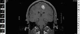 What are disease of brain