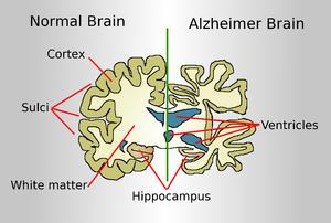 What are epilepsy causes