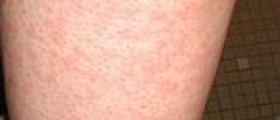 What are hives?