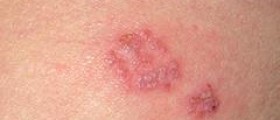 What can herpes support groups do for you?