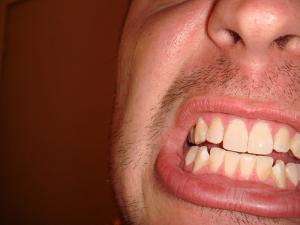What causes yellow teeth