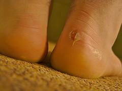 What happens if you pop a blister