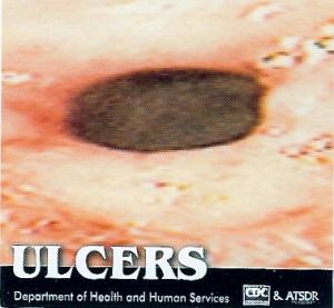 What is a peptic ulcer