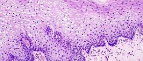 What is American cancer society?