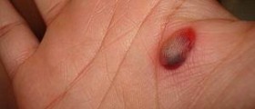 What is blood blister?