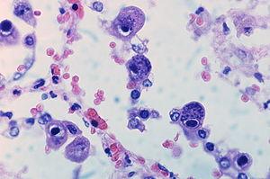 What is Cytokine storm?