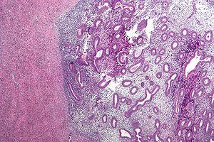 What is endometriosis