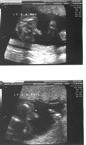 What is fetal monitoring?