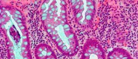 What is primary hyperparathyroidism