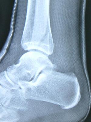 What is spiral fracture | General center | SteadyHealth.com