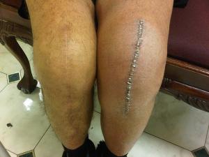 What is total knee replacement?