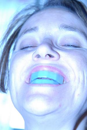 Which teeth whitening system to select?