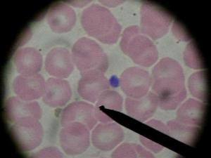 White blood cells: diseases and disorders