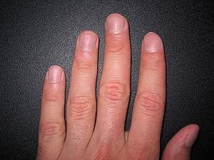 White spots on fingernails