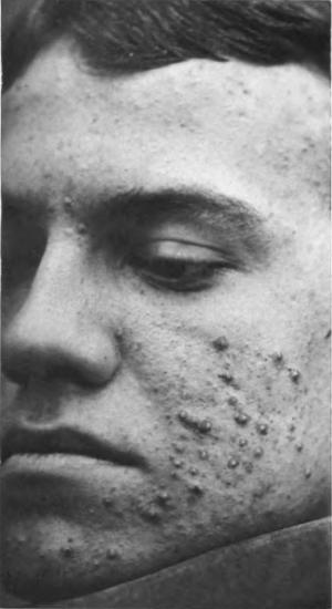 Why acne laser treatment is gaining popularity