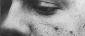 Why acne laser treatment is gaining popularity