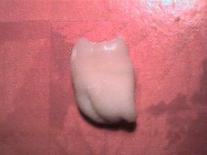Wisdom teeth pain after removal