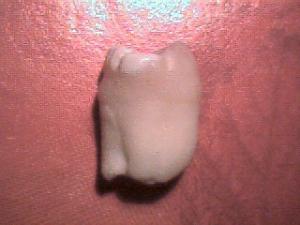 Wisdom teeth recovery time