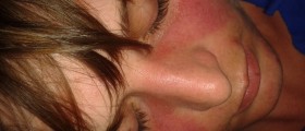 How To Cope With Lupus