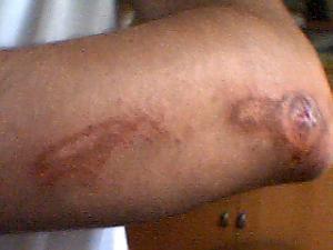 Wound dehiscence facts