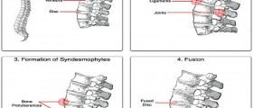 Beware Of Ankylosing Spondylitis : Maybe You Are It's Next Victim