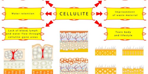 The Most Common Causes Of Annoying Cellulite
